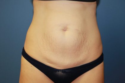 Tummy Tuck Before & After Patient #6434