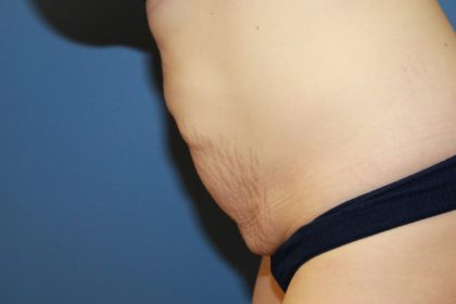 Tummy Tuck Before & After Patient #6434