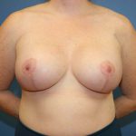 Breast Augmentation Before & After Patient #7363