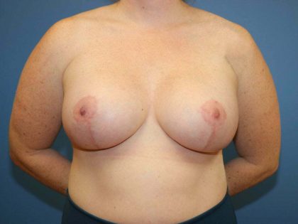 Breast Augmentation + Lift Before & After Patient #7614