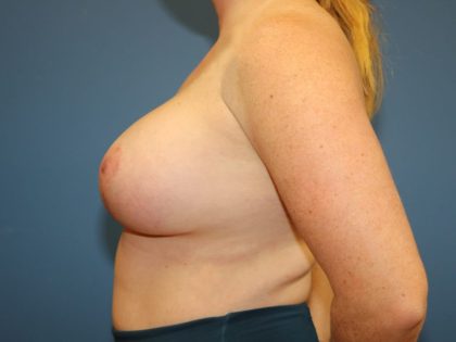 Breast Augmentation Before & After Patient #7363