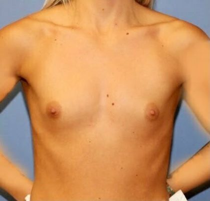 Breast Augmentation Before & After Patient #7306