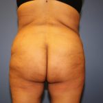 Brazilian Butt Lift Before & After Patient #5810