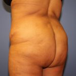 Brazilian Butt Lift Before & After Patient #5810