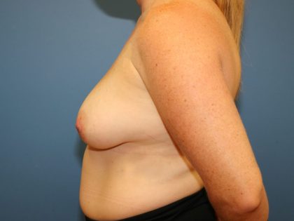 Breast Augmentation + Lift Before & After Patient #7614