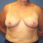 Breast Reduction Before & After Patient #6970