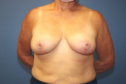 Breast Reduction Before & After Patient #6970