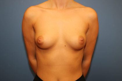 Breast Augmentation Before & After Patient #7394