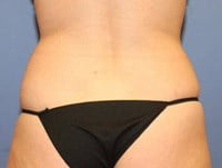 CoolSculpting Before & After Patient #5857