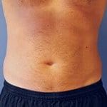 CoolSculpting Before & After Patient #5858