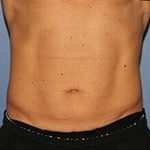 CoolSculpting Before & After Patient #5858