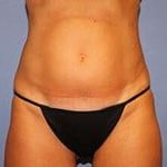 CoolSculpting Before & After Patient #5854