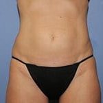 CoolSculpting Before & After Patient #5854