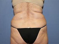 CoolSculpting Before & After Patient #5856