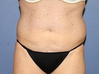 CoolSculpting Before & After Patient #5859