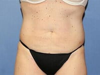 CoolSculpting Before & After Patient #5859