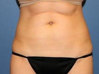 CoolSculpting Before & After Patient #5860