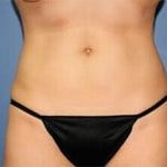 CoolSculpting Before & After Patient #5860