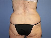 CoolSculpting Before & After Patient #5856