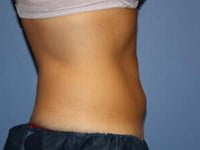 CoolSculpting Before & After Patient #5861
