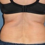 CoolSculpting Before & After Patient #5862