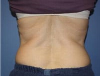 CoolSculpting Before & After Patient #5862