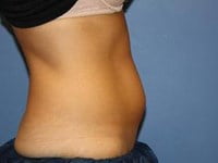 CoolSculpting Before & After Patient #5861