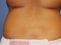 CoolSculpting Before & After Patient #5863