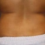 CoolSculpting Before & After Patient #5863