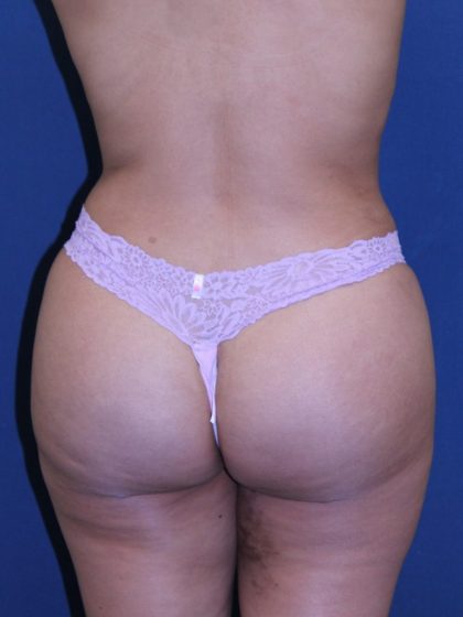 Brazilian Butt Lift Before & After Patient #5809