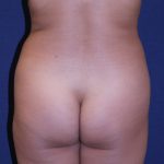Brazilian Butt Lift Before & After Patient #5809