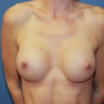 Breast Augmentation Before & After Patient #7364