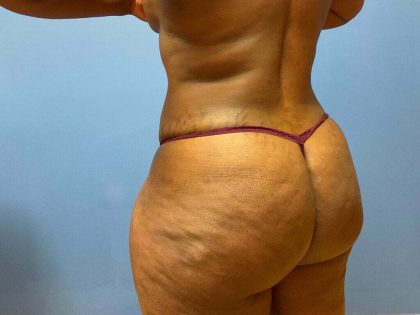 Liposuction Before & After Patient #5876