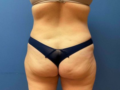 Tummy Tuck Before & After Patient #6438