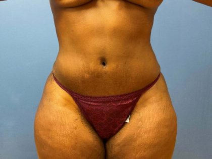 Liposuction Before & After Patient #5876
