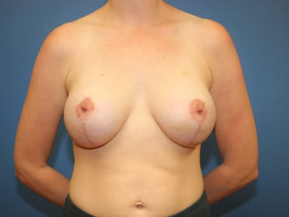 Breast Augmentation Before & After Patient #7396