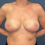 Breast Reduction Before & After Patient #6974
