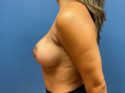 Breast Augmentation Before & After Patient #7398