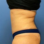 Tummy Tuck Before & After Patient #6528