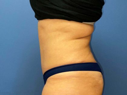 Tummy Tuck Before & After Patient #6528