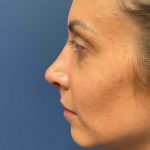 Rhinoplasty Before & After Patient #6715