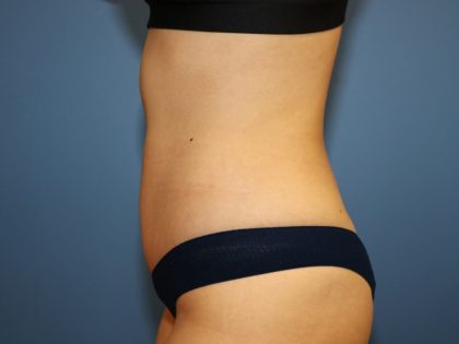 Tummy Tuck Before & After Patient #6435
