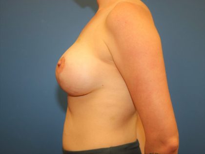 Breast Augmentation + Lift Before & After Patient #7617
