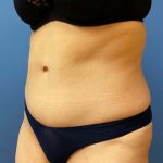 Tummy Tuck Before & After Patient #6437