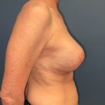 Breast Revision Before & After Patient #7492