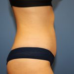Tummy Tuck Before & After Patient #6435