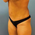 Tummy Tuck Before & After Patient #6527