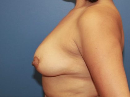 Breast Augmentation Before & After Patient #7360