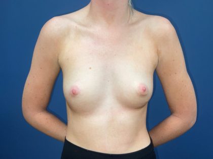 Breast Augmentation Before & After Patient #7400