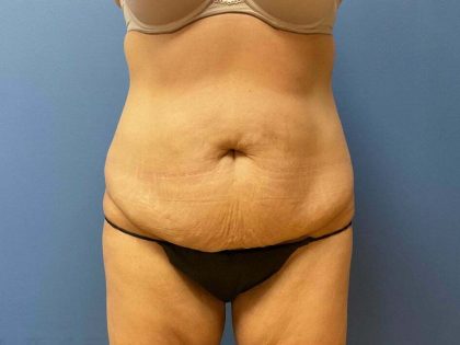 Tummy Tuck Before & After Patient #6598